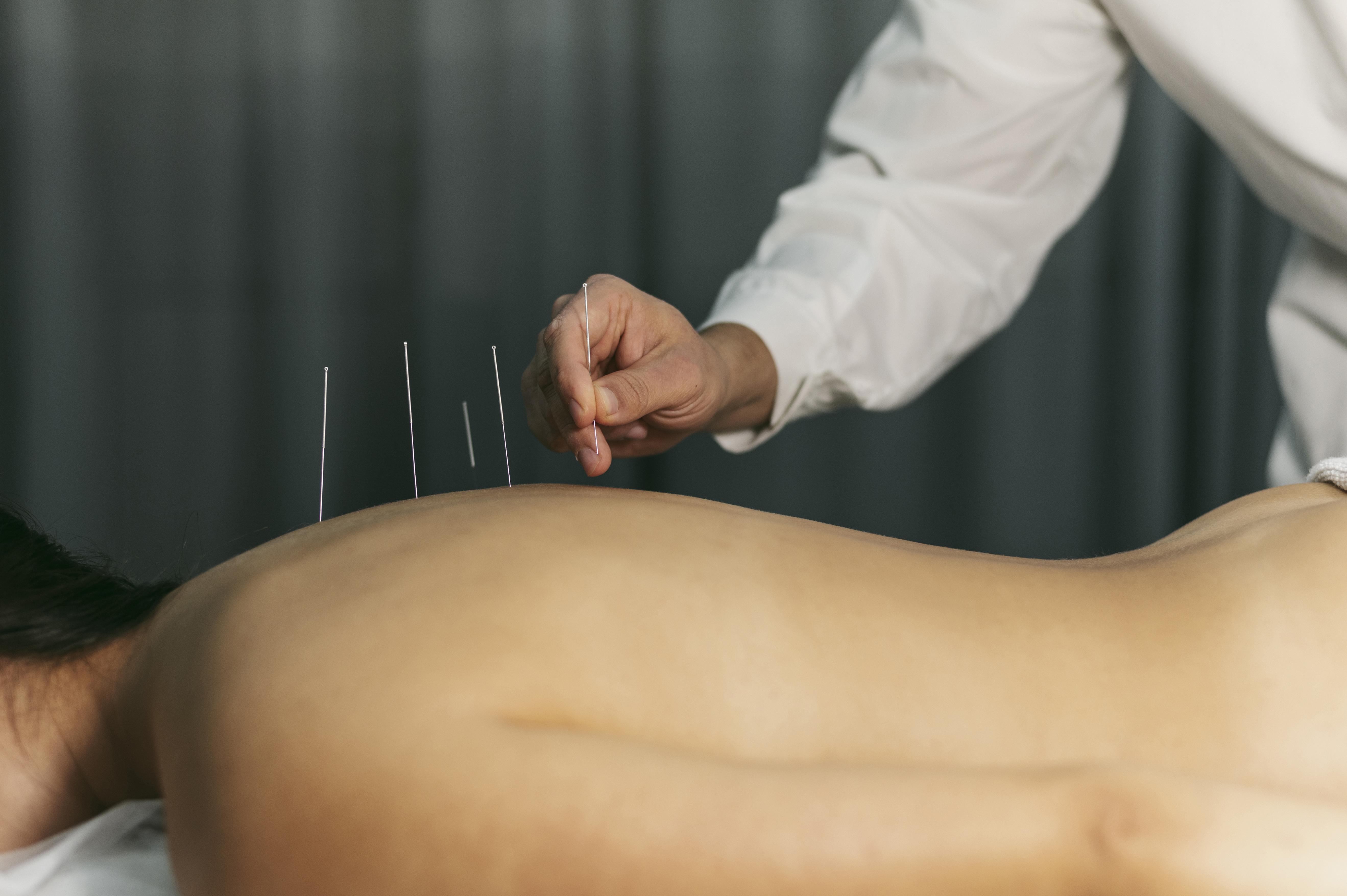 Cosmetic Acupuncture